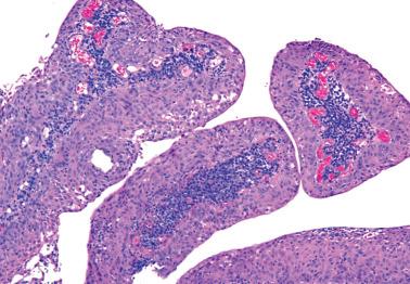 Fig. 5.19, Papillary immature metaplasia.