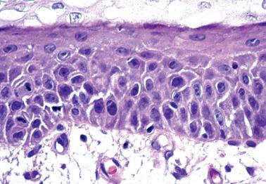 Fig. 5.20, Reactive atypia. Note prominent nucleoli.