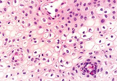 Fig. 5.21, Pseudokoilocytosis in a postmenopausal woman.