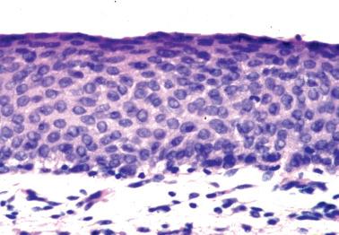 Fig. 5.22, Atrophy. The cells have a high N:C ratio and show no maturation, but the nuclei lack dysplastic features and mitotic figures.