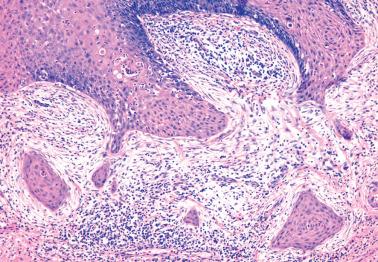 Fig. 5.23, Superficially invasive squamous cell carcinoma, stage IA1. Tongues and nests of invasive tumor arising from the overlying HSIL are associated with a stromal reaction.