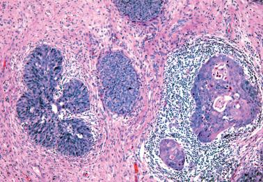 Fig. 5.24, Superficially invasive squamous cell carcinoma, stage IA1. Note maturation and surrounding inflammatory reaction of invasive foci (two nests on right) contrasting with the nests of HSIL (left and top).