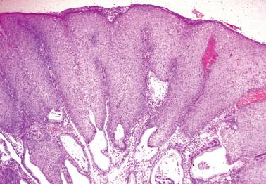 Fig. 5.3, Condyloma acuminatum, endophytic growth pattern.