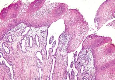 Fig. 5.4, Condyloma acuminatum, mainly flat but with a few early papillae.