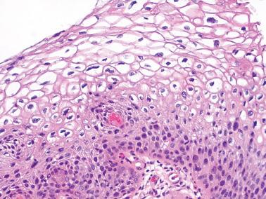 Fig. 5.6, Low-grade squamous intraepithelial lesion (CIN 1). Typical koilocytic atypia with hyperchromatic irregular nuclei and occasional binucleate cells are seen.