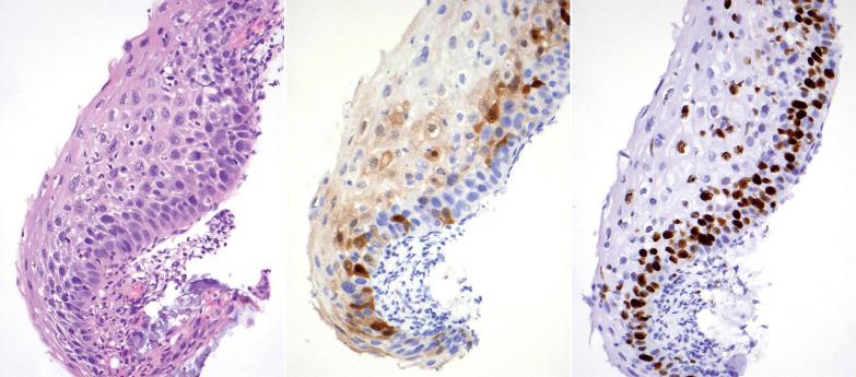 Fig. 5.7, LSIL (CIN 1) with p16 and Ki-67 immunostains. This dysplastic squamous epithelium is potentially morphologically concerning for HSIL (CIN 2) on H&E. The p16 immunostain (middle) demonstrates focal patchy staining, and the Ki-67 (right) is more prominent along the basal layer, making a diagnosis of LSIL (CIN 1) most appropriate.