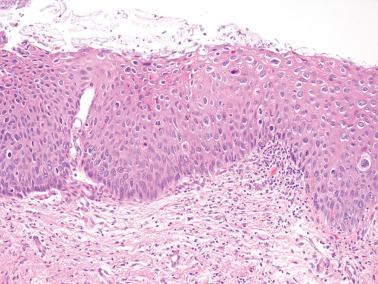 Fig. 5.8, HSIL (CIN 2) with koilocytosis.