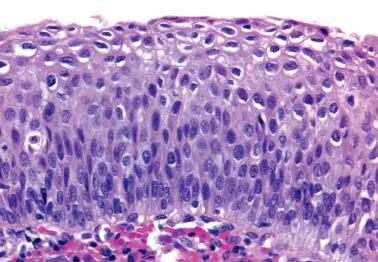 Fig. 5.9, HSIL (CIN 3) with koilocytosis.