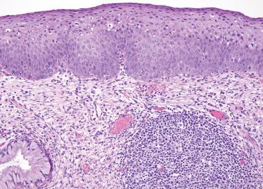 Fig. 5.10, HSIL (CIN 2–3).