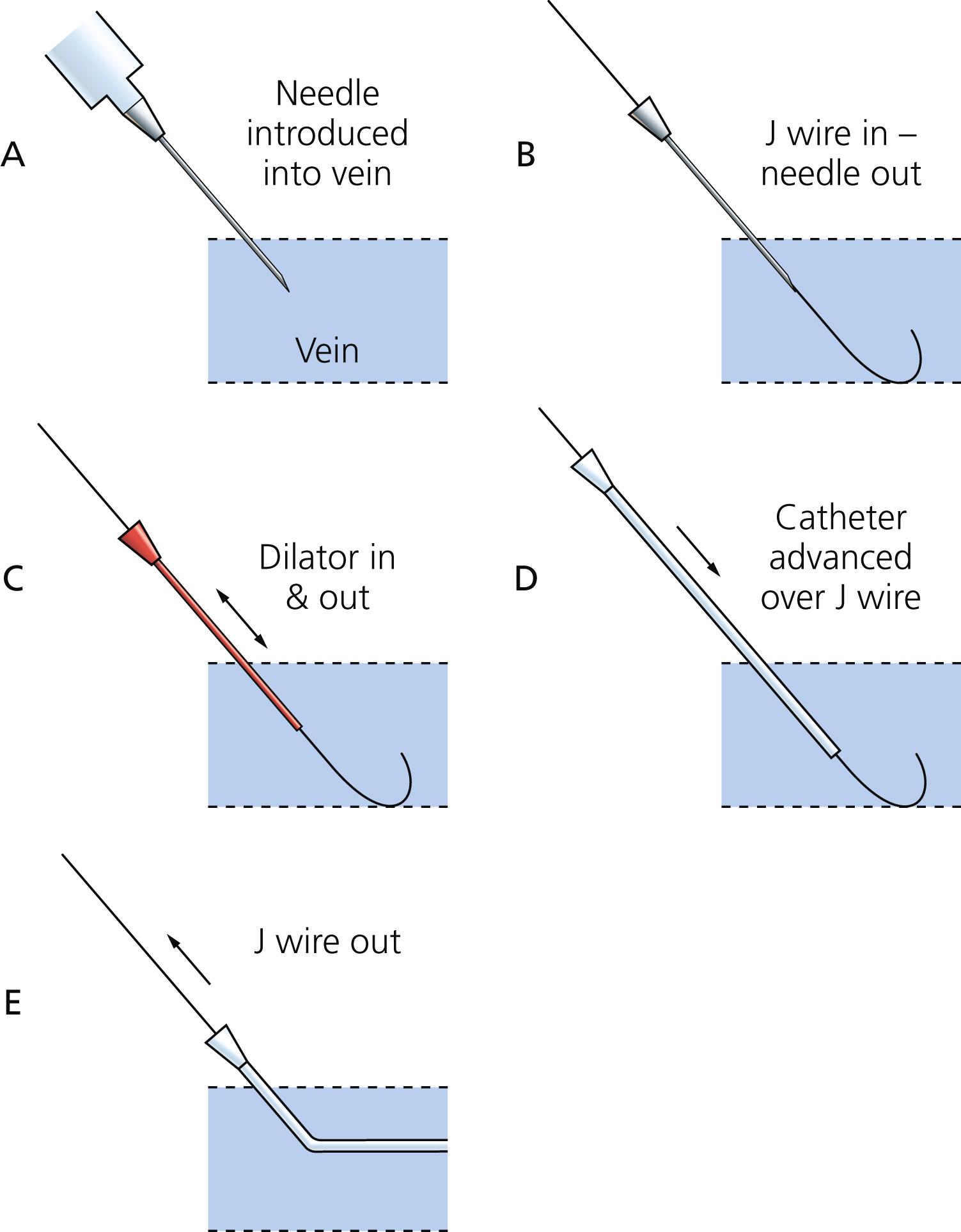 Fig. 11.10, The Seldinger technique. See text for details.