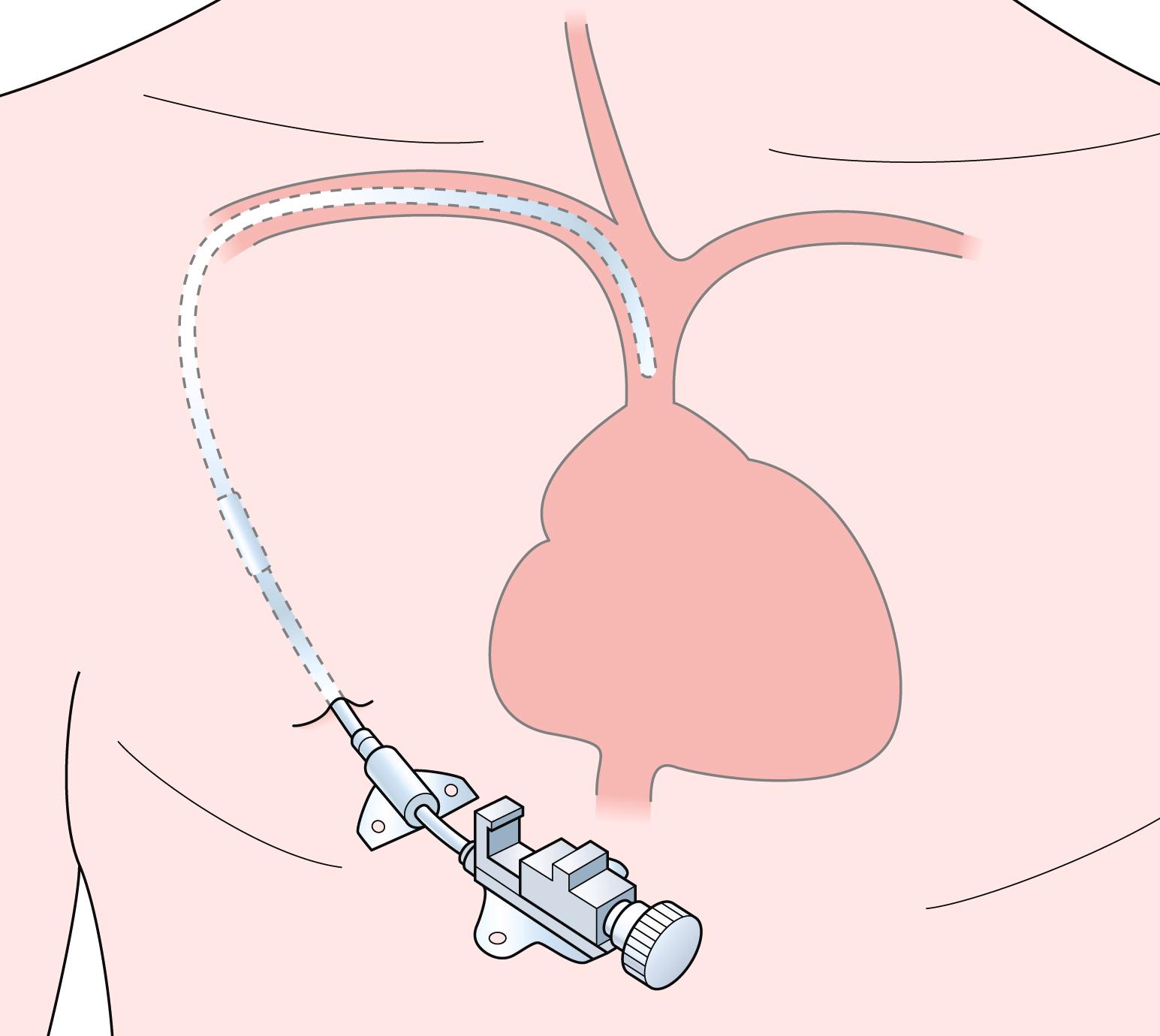 Fig. 11.20, Final position of a tunnelled Hickman catheter.