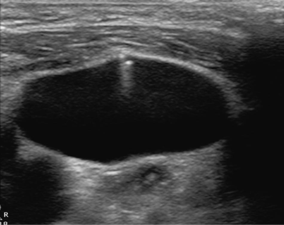 Fig. 11.11, Ultrasound image showing a needle in the internal jugular vein. The carotid artery is at the left lower corner.
