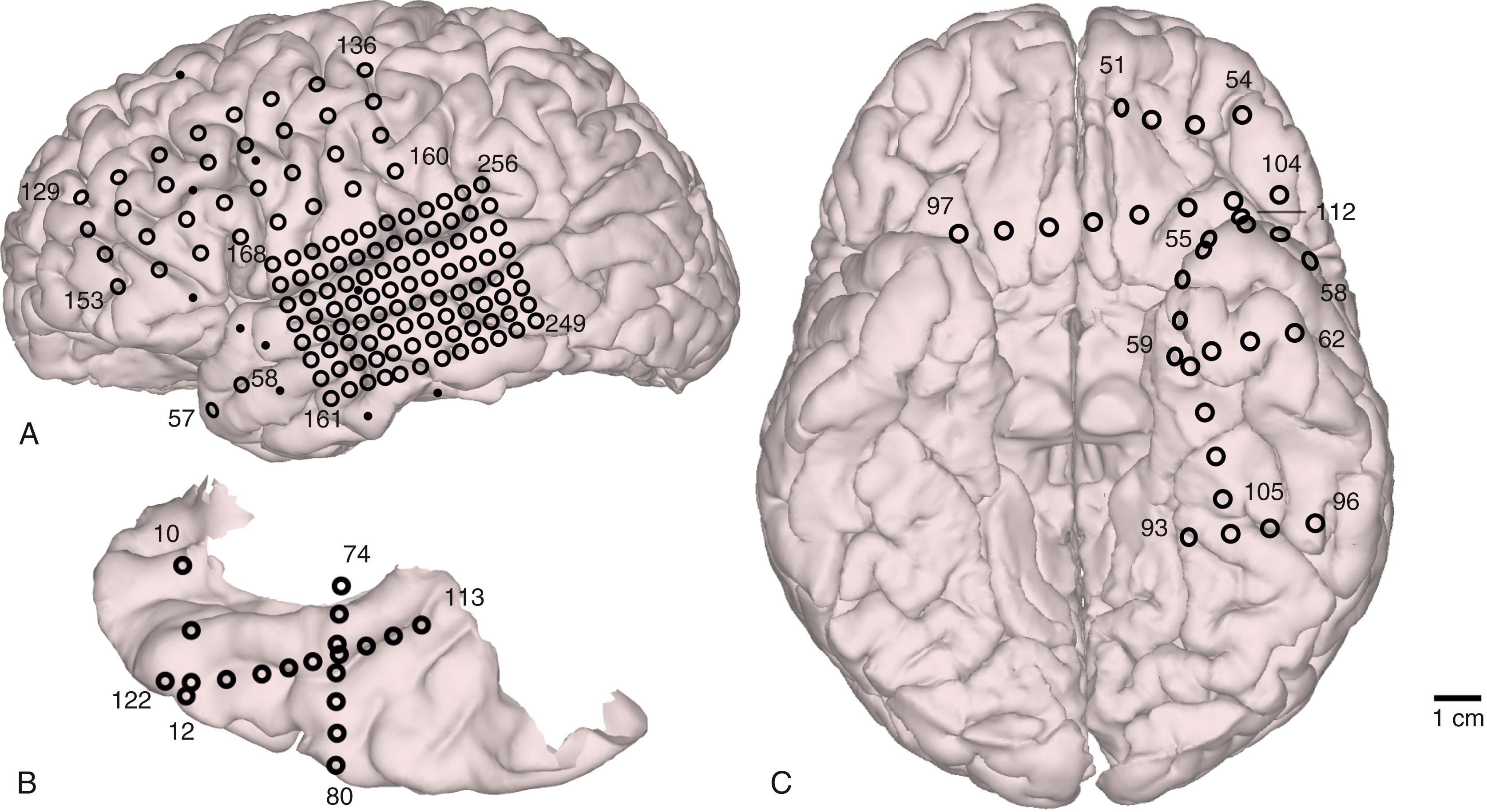 Figure 93.2, Positions of subdural contacts are mapped on a three-dimensional surface rendering of a preoperative magnetic resonance image.