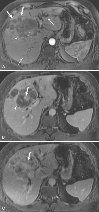Figure 4.3, Cholangiocarcinoma. A 48-year-old female with jaundice shows an irregular mass. A , On the arterial phase of magnetic resonance imaging, the mass ( arrowhead ) shows minimal peripheral enhancement. Satellite nodules are seen ( thick arrows ). There is bilobar biliary dilation ( thin arrow ). B , On the venous phase, the mass ( arrowhead ) shows more enhancement ( thick arrow ). C , On the 5-minute delayed phase, there is gradual centripetal enhancement ( thick arrow ). The slow progressive inhomogeneous enhancement is typical of cholangiocarcinoma.