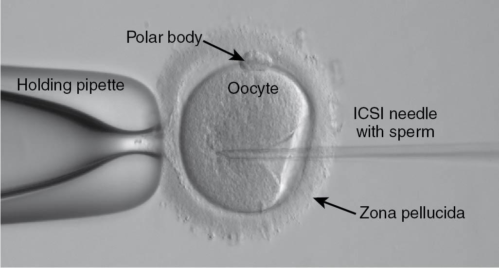 Fig. 41.1, Intracytoplasmic sperm injection (ICSI).