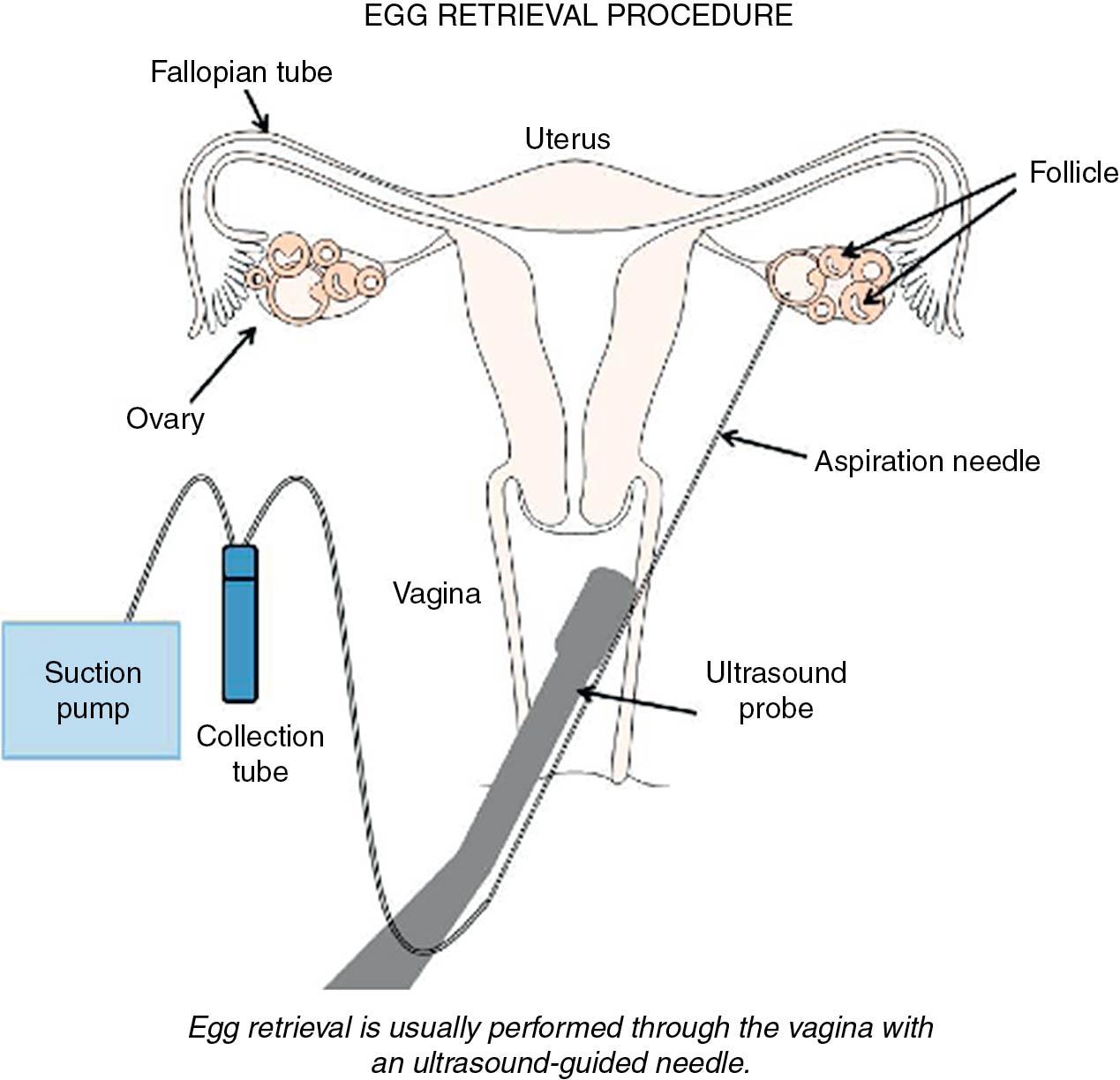 Fig. 41.3, Diagram of oocyte retrieval.