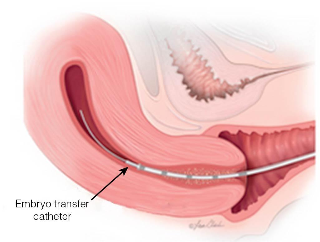 Fig. 41.7, Embryo transfer with catheter.