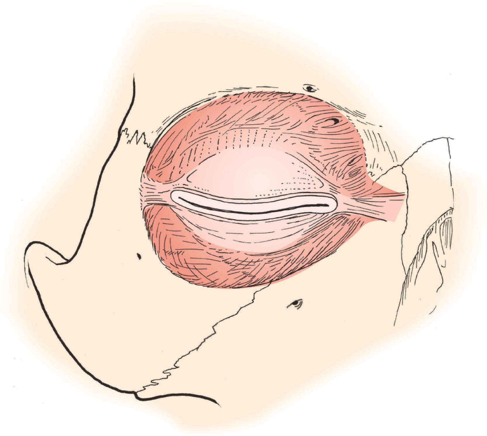 Figure 6.11, The orbital septum.