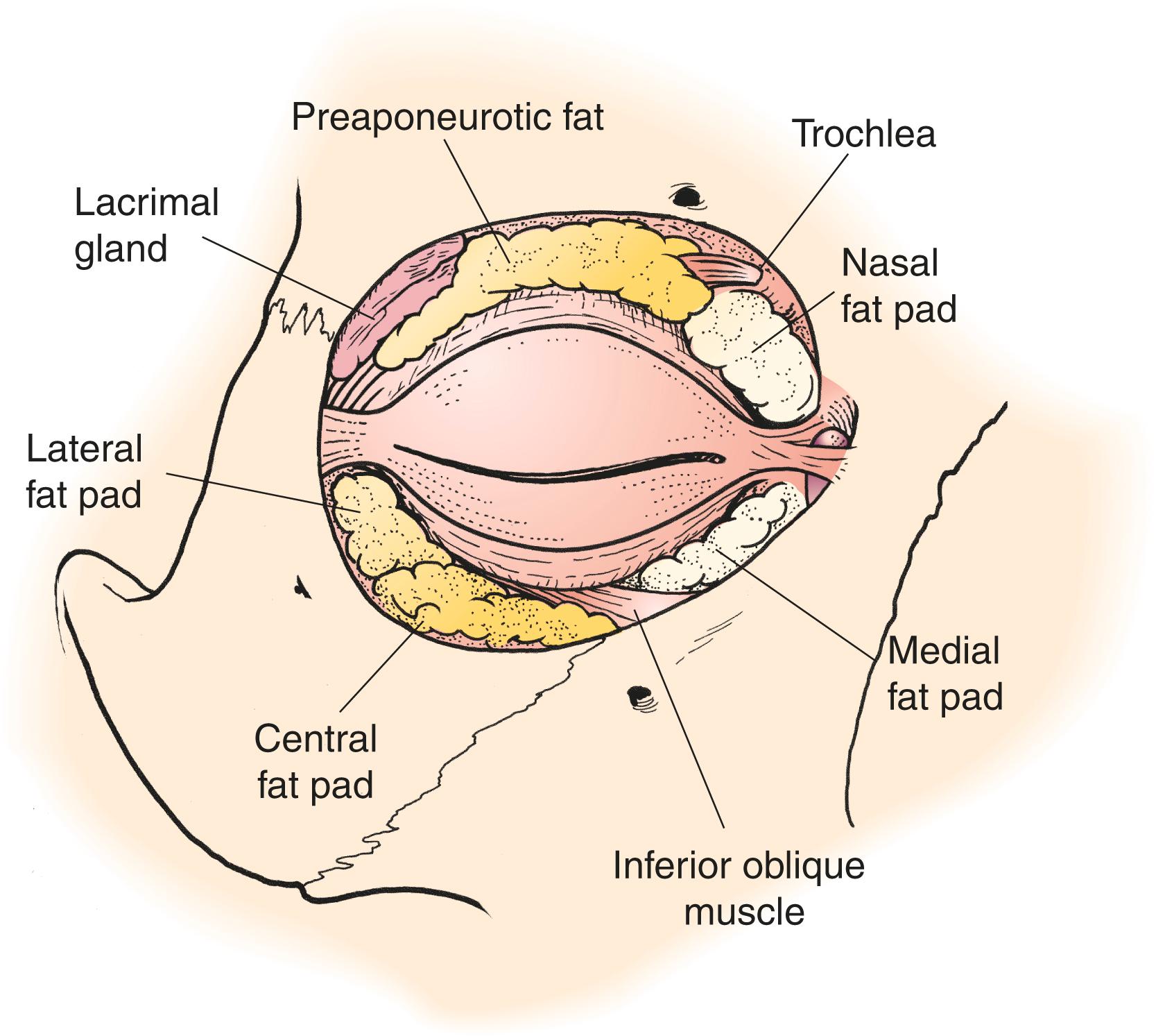 Figure 6.12, The preaponeurotic fat. Note central and nasal fat pads. Lacrimal gland is temporal to the central fat pad.