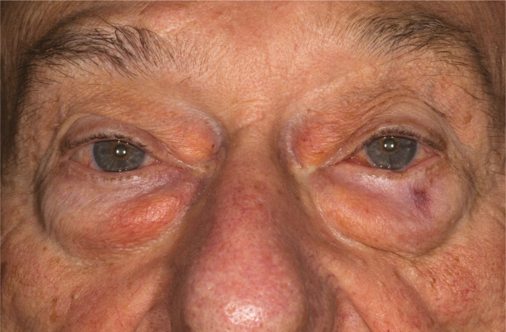 Figure 6.13, Upper and lower eyelid fat prolapse. Note prolapse of upper medial fat pads and all three lower eyelid fat pads. Also note the upper eyelid ptosis and small incisional biopsy site on the left lower eyelid for presumed basal cell carcinoma.