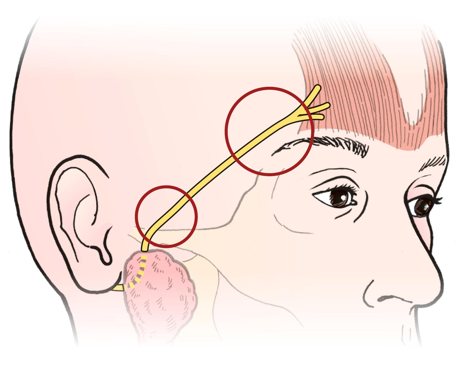 Figure 6.15, The path of the temporal branch of the facial nerve. Note danger zones over the zygomatic arch and at the tail of the brow. When operating in this region, it is worth drawing a line over this path as a reminder of the position of the frontal branch of the facial nerve. The most superficial position of the temporal branch is overlying the zygomatic arch.