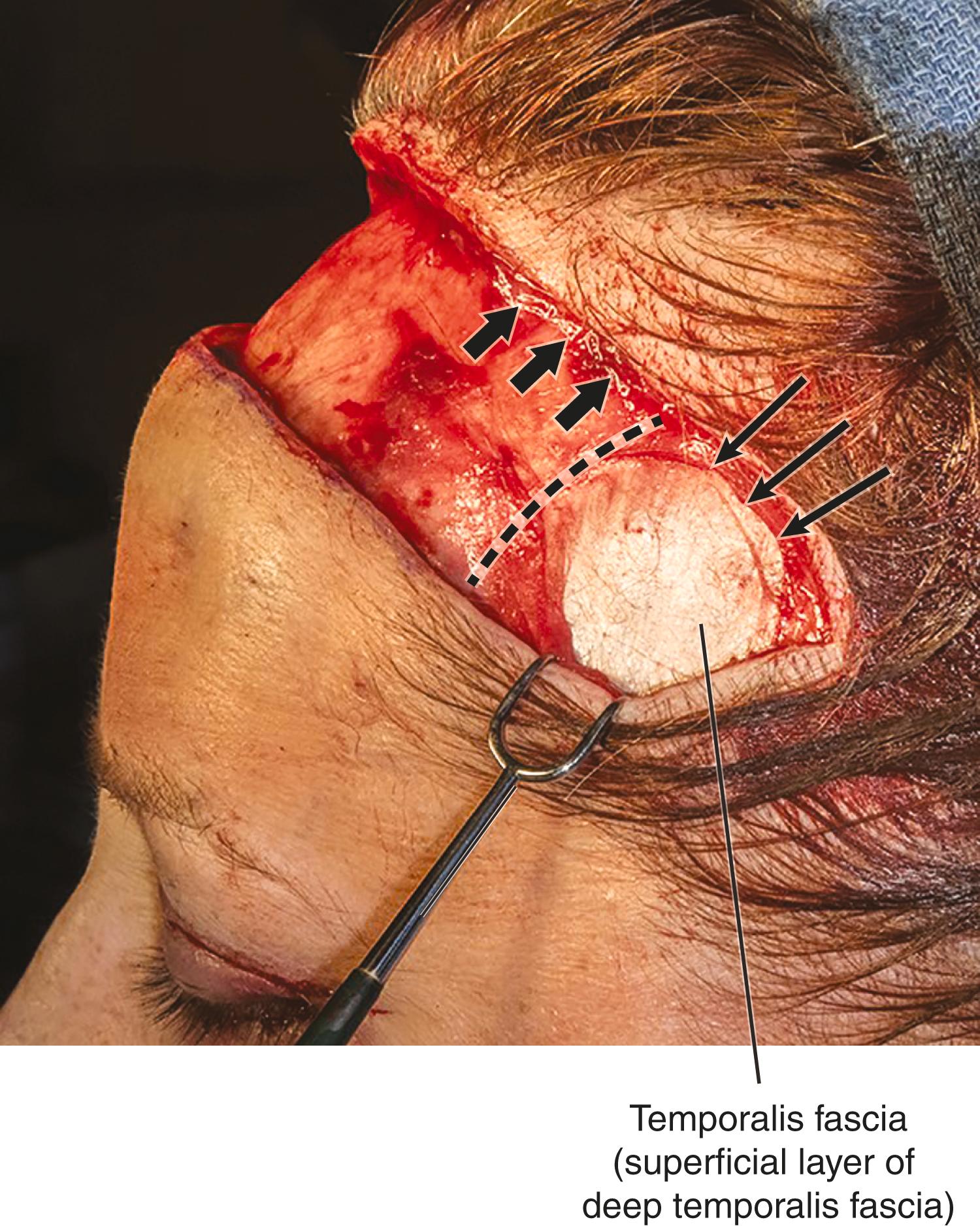 Figure 6.16, Pretrichial browplasty incision. A strip of forehead tissue has been removed and the wound is retracted. The temporal parietal fascia (TPF) has been opened to expose the temporalis fascia, seen as the glistening white layer just superior to the skin hook. At the upper edge of the deep fascia, a rim of TPF is visible ( thin arrows ), which is continuous with the edge of the galea medially ( thick arrows ). The conjoint tendon is marked with a dashed line .