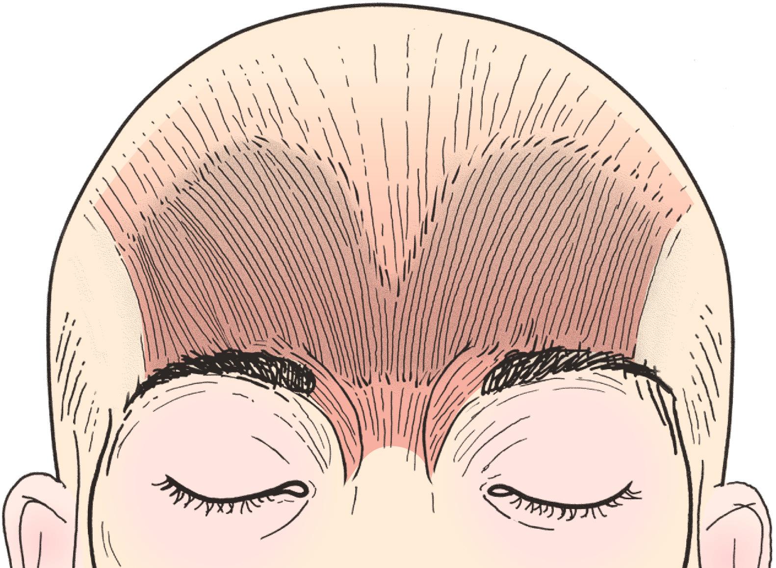 Figure 6.3, The frontalis muscle. Note that the frontalis muscle ends lateral to the body of the eyebrow. Note the presence of the corrugator superciliaris and procerus muscles.