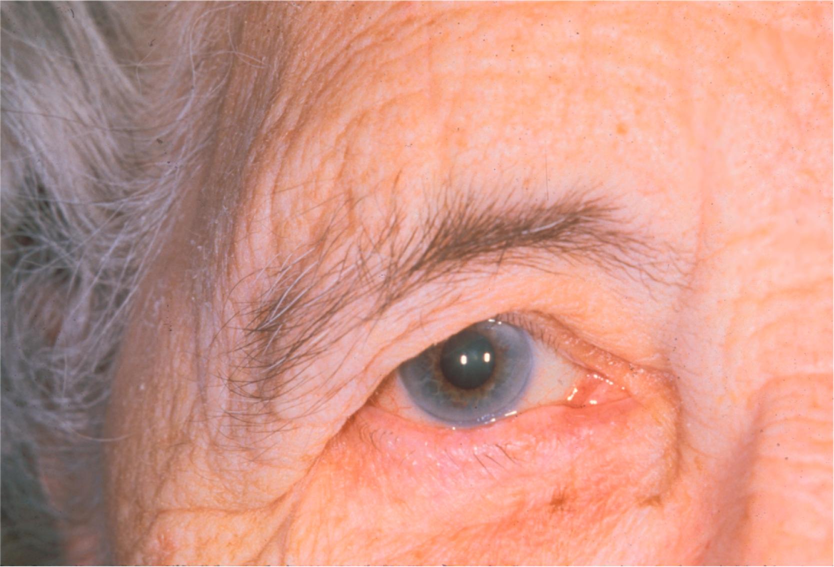 Figure 6.4, Temporal eyebrow droop is one of the most common, yet unappreciated, causes of visual loss.