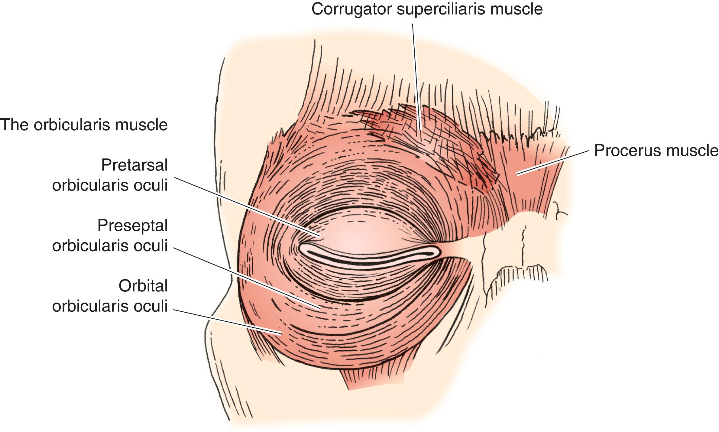 Figure 6.5, Muscles that close the eyes: the orbicularis muscle, pretarsal, preseptal, and orbital; corrugator muscle; and procerus muscle.