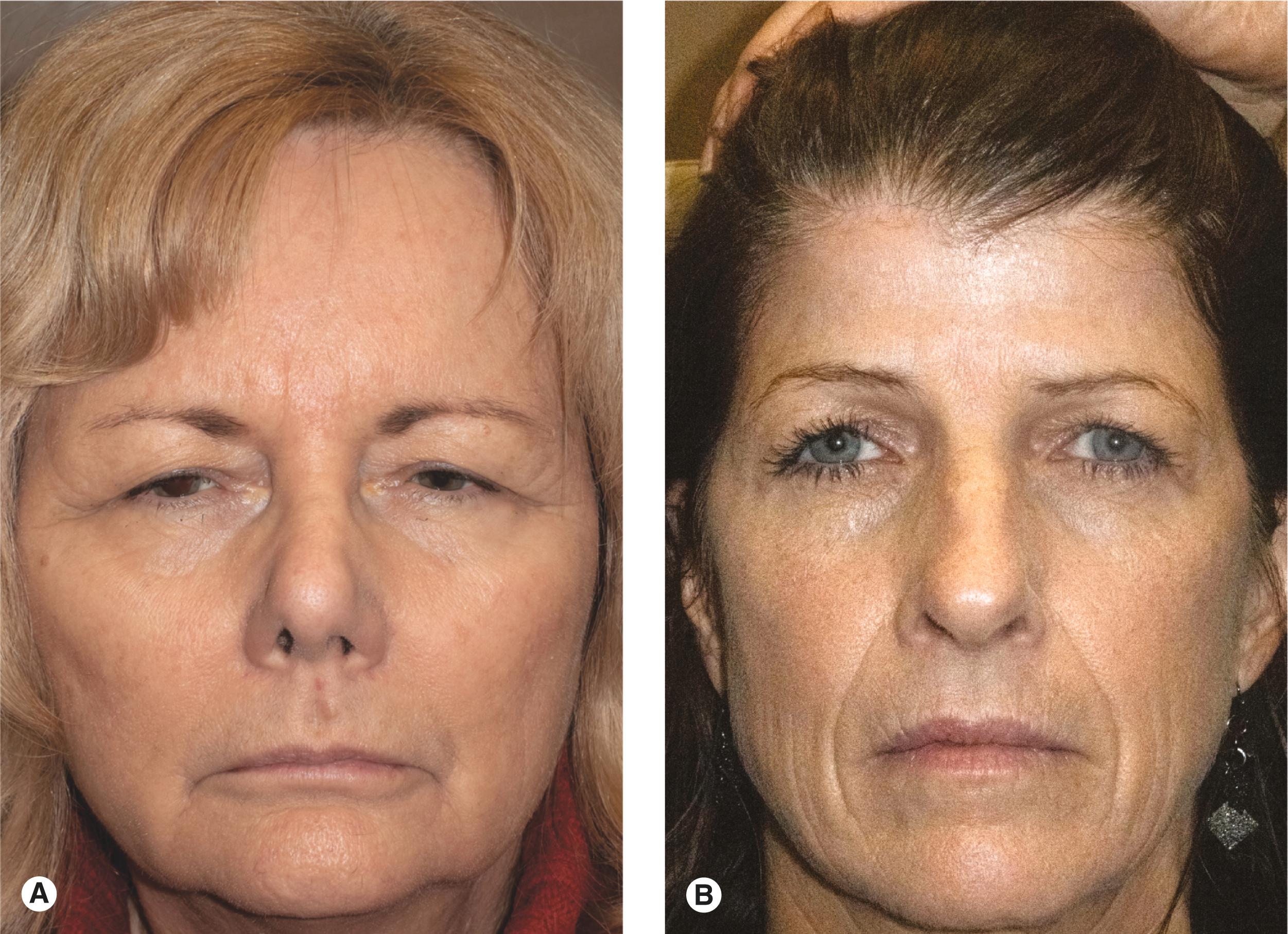 Figure 6.7, Forehead height. ( A ) High forehead, greater than one third of the face. A pretrichial forehead lift would improve the facial proportions and improve the eyebrow position. An upper blepharoplasty and ptosis repair are also indicated. ( B ) Low forehead, less than one third of the face. An endobrow or coronal forehead lift would improve the facial proportions and improve the eyebrow position. An upper blepharoplasty would improve the patient’s appearance, as well.