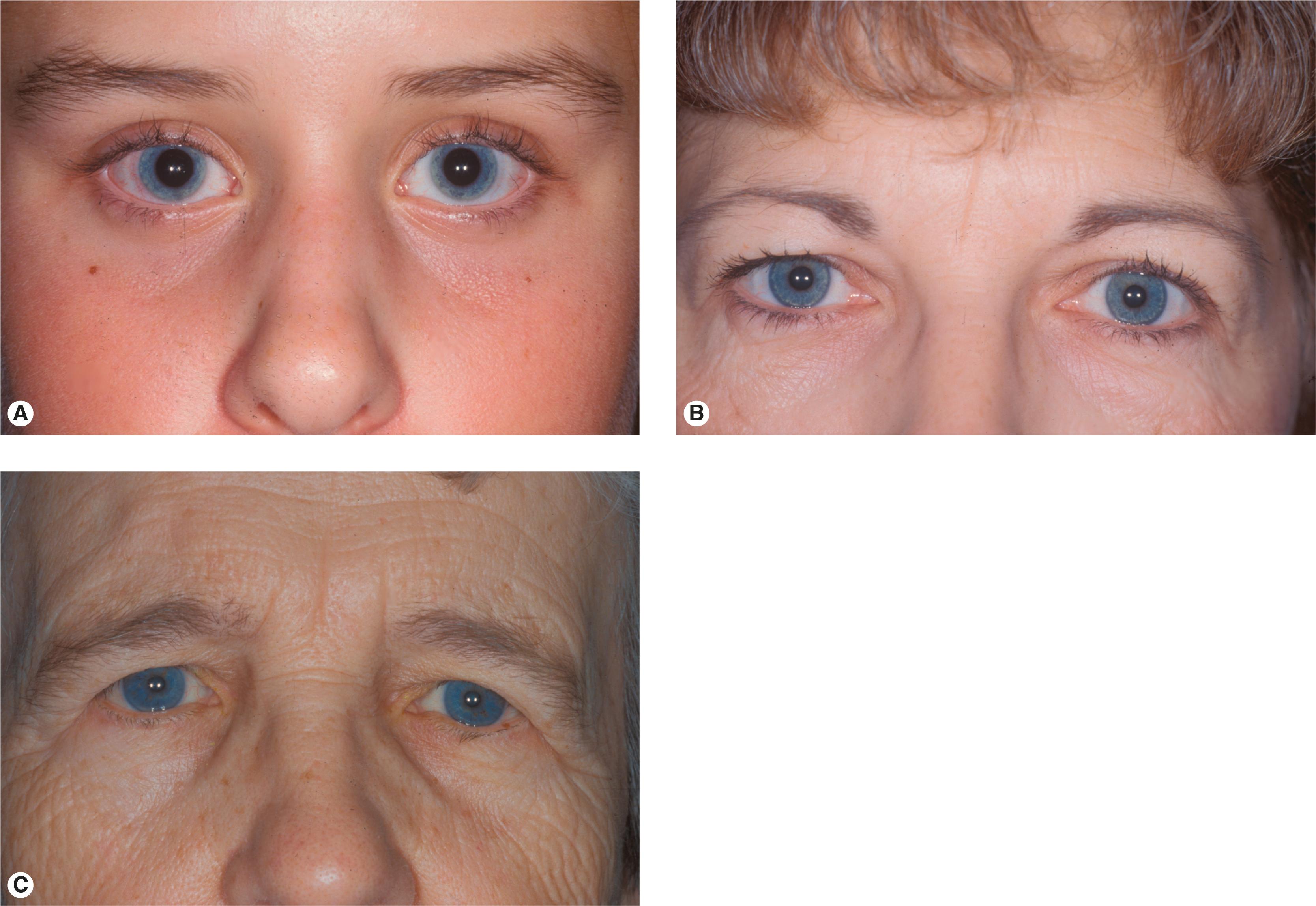 Figure 6.8, The typical brow position by age. Note progression of eyebrow ptosis crowding the sulcus. ( A ) Teenager: the eyebrow is well supported and independent of the eyelid. ( B ) Middle-aged woman: mild generalized eyebrow ptosis contributing to the fullness of the sulcus. ( C ) Older woman: note the prominent temporal eyebrow ptosis.