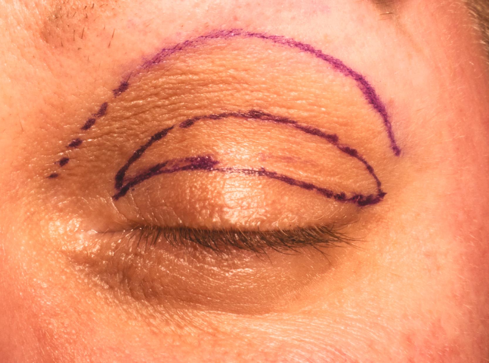 Figure 6.10, Eyelid skin pigmentation. The eyelid skin, when compared with the eyebrow and cheek, is thinner, more textured, and more pigmented. Upper line denotes the start of the eyebrow skin. Ellipse shows the planned blepharoplasty incision leaving an adequate amount of eyelid skin for normal blinking. You should also be aware of the difference in the amount and position of the underlying fat pads. Positioning the tissues surrounding the eyelid using a cheek lift or browplasty helps make the transition from the eyelids to the cheek and brow more graceful, an important sign of youth.