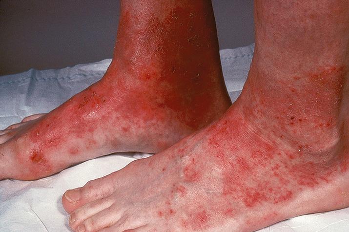 Fig. 12.1, Bilateral irritant contact dermatitis of the feet and ankles due to chronic occlusive footwear.