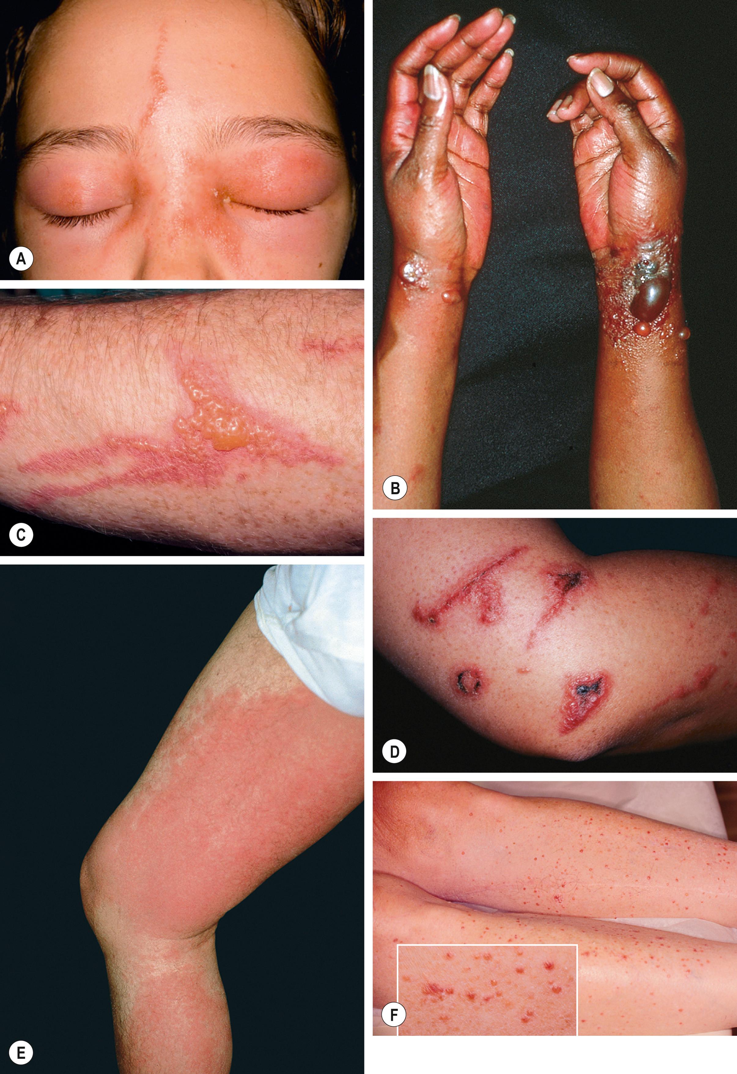 Fig. 12.12, Clinical manifestations of Anacardiaceae dermatitis.