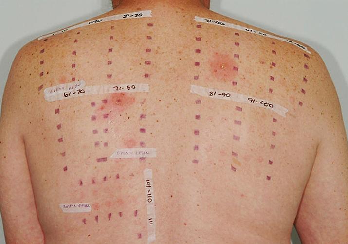 Fig. 12.14, Sites of specific patch tests labelled for future reference following removal of the chambers.