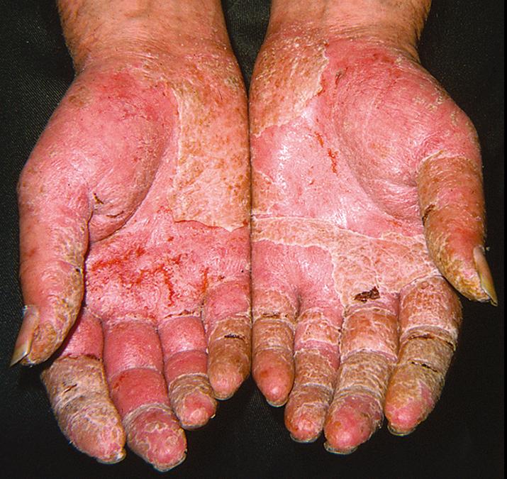 Fig. 12.2, Bilateral irritant contact dermatitis of the palms secondary to repeated contact with paint solvents.