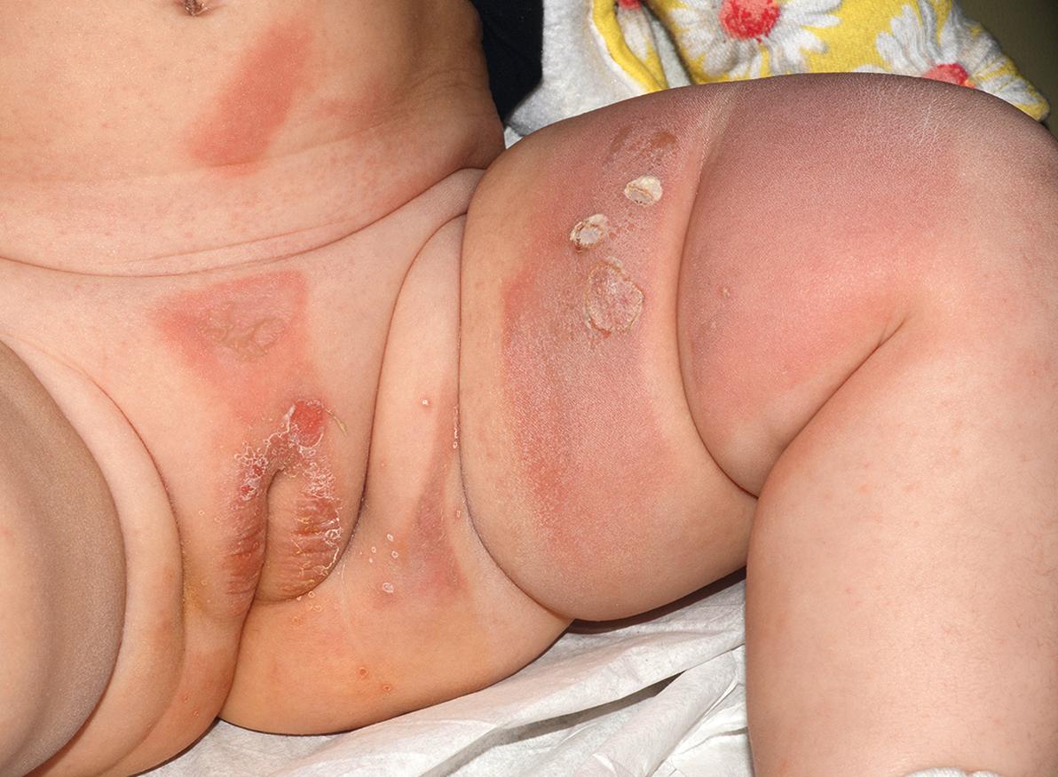 Fig. 12.4, Chemical burn from topical application of apple cider vinegar mimicking child abuse in an infant.