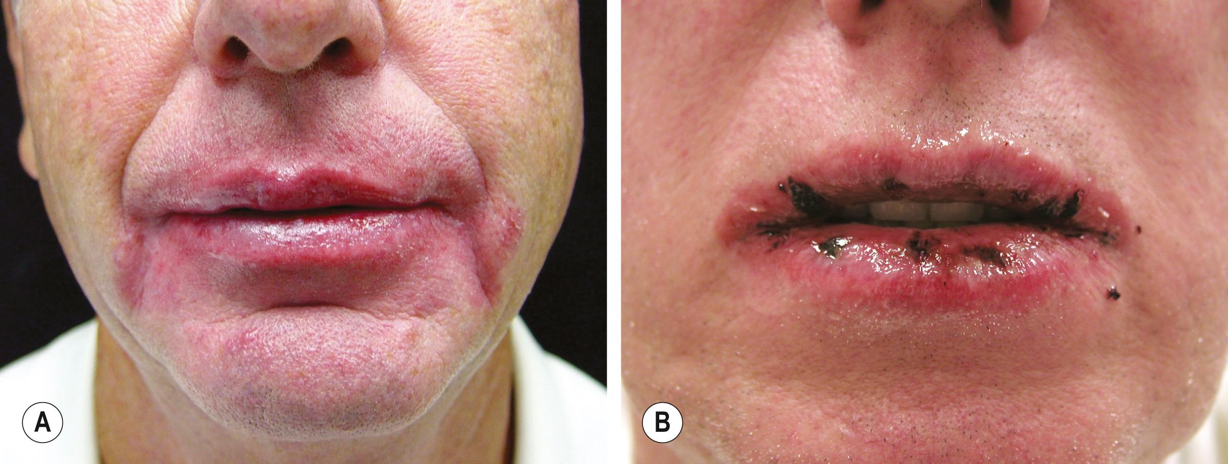 Fig. 12.5, Cheilitis due to irritant versus allergic contact dermatitis. A Irritant contact dermatitis – this patient had the habit of licking his lips and there is involvement of the vermilion and cutaneous lips as well as the perioral region. B Allergic contact dermatitis to oxybenzone with involvement of the upper and lower lips.