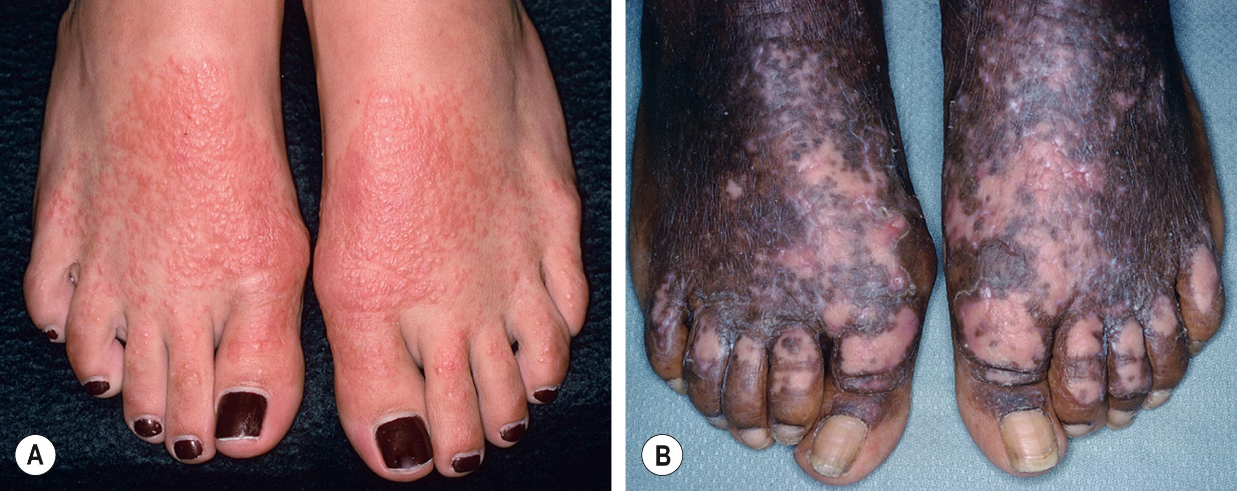 Fig. 12.6, Allergic contact dermatitis to shoes – acute versus chronic.