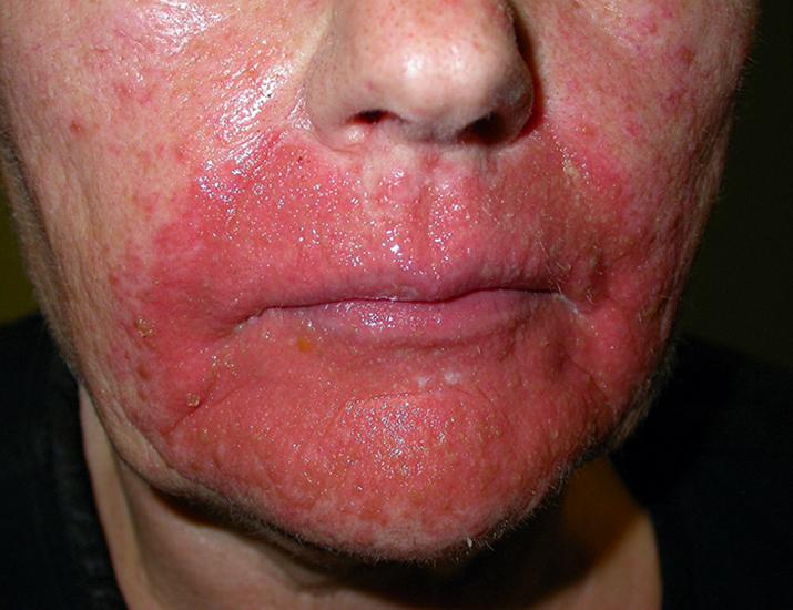 Fig. 12.7, Acute vesiculobullous allergic contact dermatitis.