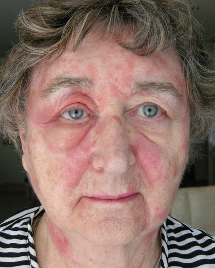 Fig. 12.8, Acute allergic contact dermatitis with a prominent component of edema.