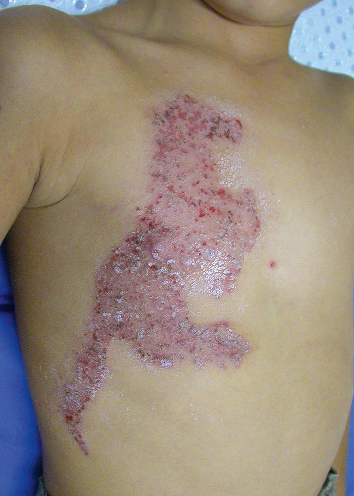 Fig. 12.10, Allergic contact dermatitis to p -phenylenediamine in a temporary tattoo.