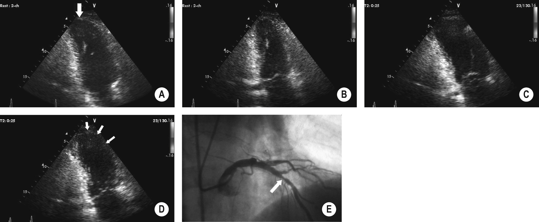 Stress echocardiography. (A) End-diastolic apical two-chamber view at rest shows thinning of the apical myocardium (arrow). (B) End-systolic apical two-chamber view at rest shows concentric contraction of left ventricle, except for the cardiac apex. (C) End-diastolic apical two-chamber view during stress (dobutamine infusion) shows dilatation of the left ventricle when compared with (A). (D) End-systolic apical two-chamber view during stress (dobutamine infusion) shows dilatation of the left ventricle due to akinesia of the anterior wall to contract (arrows). (E) Selective coronary arteriogram (right anterior oblique with cranial angulation) in the same patient shows a significant left anterior descending coronary artery stenosis (arrow). *