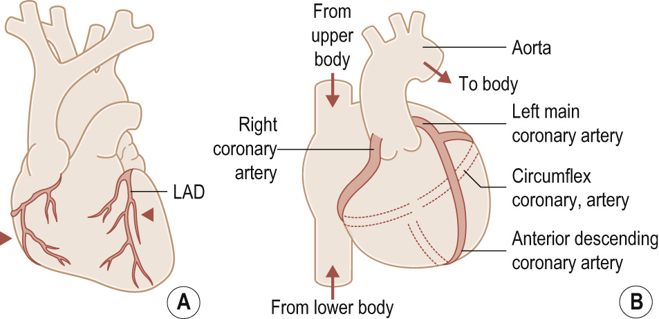 Normal coronary anatomy. (A) Anterior view of the heart showing the left anterior descending (LAD) and right coronary arteries (black arrowheads). (B) Diagrammatic depiction of the three coronary arteries. The dotted lines represent the atrioventricular (AV) and interventricular grooves posteriorly . The continuous parallel lines represent the same grooves anteriorly . The interventricular groove for the left anterior descending artery is the more vertical of the two grooves.