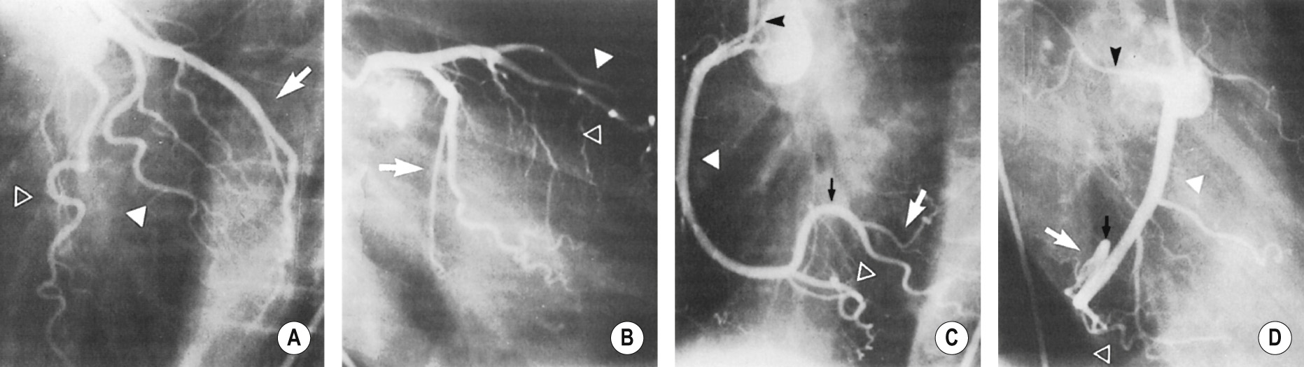 Normal coronary arteriography. (A,B) Left coronary artery: the normal coronary artery has a smooth, gently tapering outline. (A) Left anterior oblique (LAO) projection ▸ (B) right anterior oblique (RAO) projection. Open arrowhead = left anterior descending artery (LAD), solid arrowhead = diagonal, branch arrow = circumflex/obtuse marginal vessels. In (B) the LAD and its diagonal branch overlap but the LAD may be identified by its septal branches and its extension to the apex of the heart. The small circumflex branch (arrow) has the characteristic straight appearance which suggests that it is running in the left atrioventricular (AV) groove. The larger obtuse marginal branch has left the AV groove and is running on the surface of the left ventricle. (C,D) Right coronary artery: (C) LAO projection ▸ (D) RAO projection. Solid white arrowhead = right coronary artery, open arrowhead = posterior descending coronary artery, black arrowhead = sinus node artery, black arrow = inverted U at the crux, white arrow = posterolateral left ventricular branch. In (C) the entire right coronary artery is seen in profile as it passes around the heart in the right side of the AV groove. The posterior descending branch is the last branch before the crux. Beyond the crux (marked by the inverted U) are posterolateral left ventricular branches supplying the free wall of the left ventricle. In (D) both the origin and the terminal part of the right coronary artery are foreshortened but the sinus node artery (black arrowhead) can be distinguished from the conus and other right ventricular (RV) branches. As seen in (D) it runs posteriorly to the atria, whereas the conal and RV branches run anteriorly to the right ventricle. *
