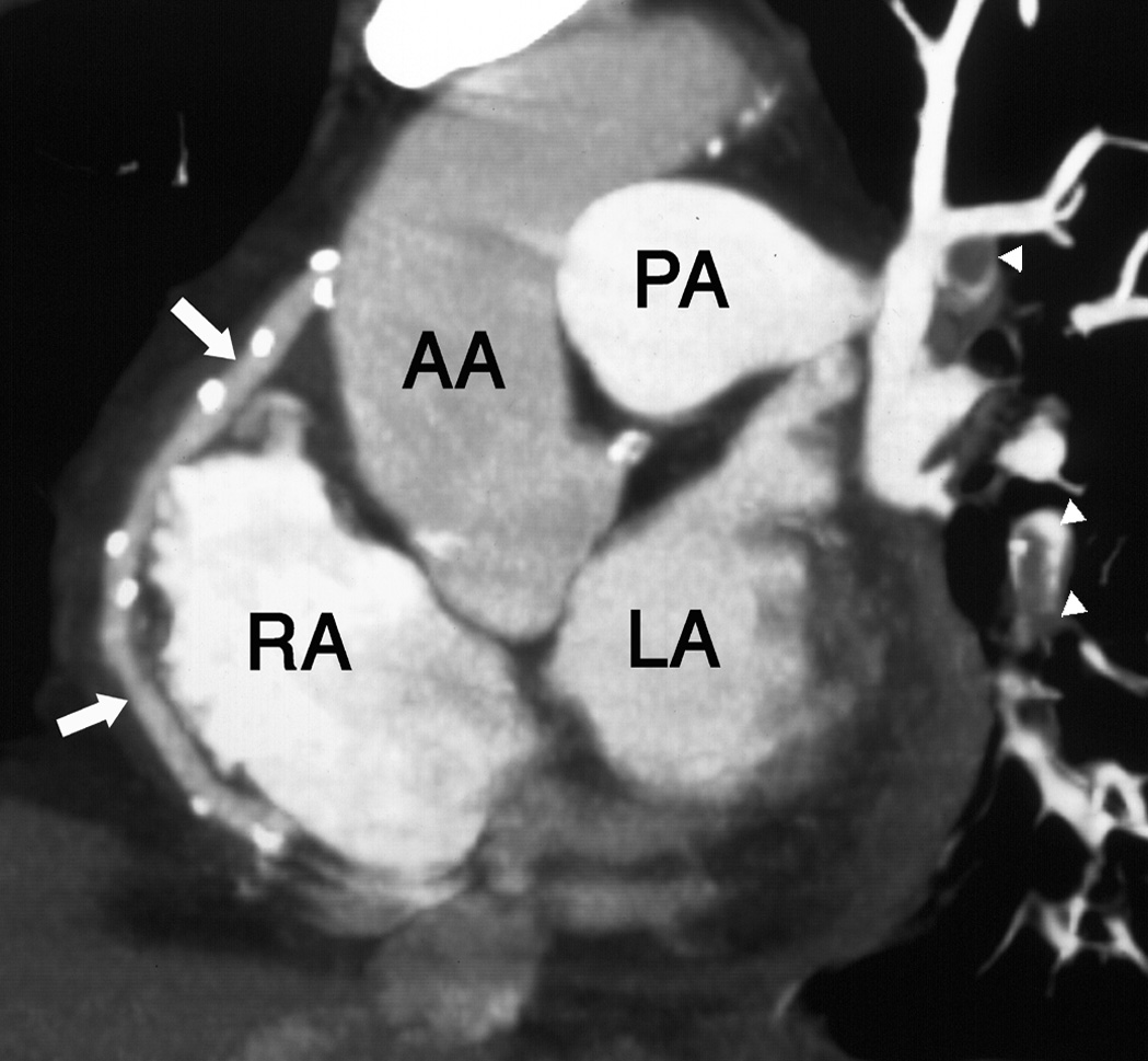 CTA of coronary artery bypass grafts. Thin maximum intensity projection (MIP) showing a patent saphenous vein bypass graft (arrows) to the distal right coronary artery. Also note thrombus in the left pulmonary arteries (arrowheads). AA = aortic arch, PA = pulmonary artery, RA = right atrium, LA = left atrium. *