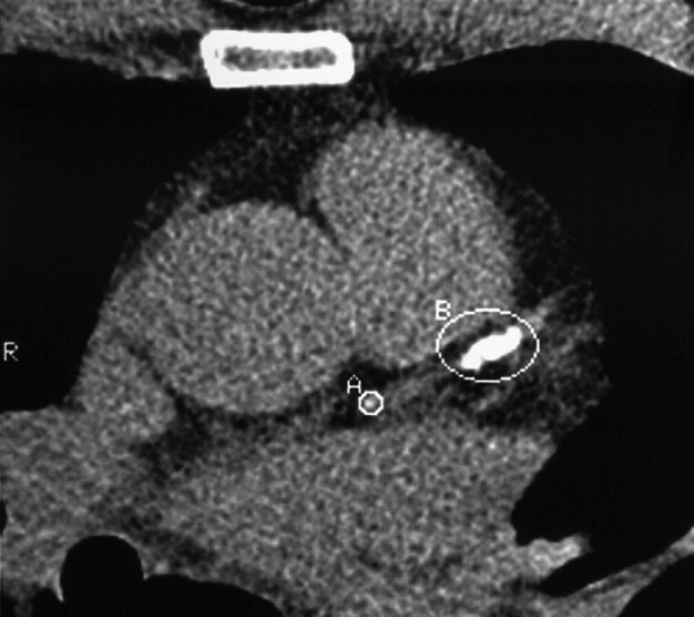 EBCT screening. EBCT image with conventional soft tissue windowing and with a threshold set at 130 HU. An area of dense calcification (circled) is identified in the proximal left anterior descending artery (LAD) – the calcium score was high (total score 887 ▸ LAD score 227). *