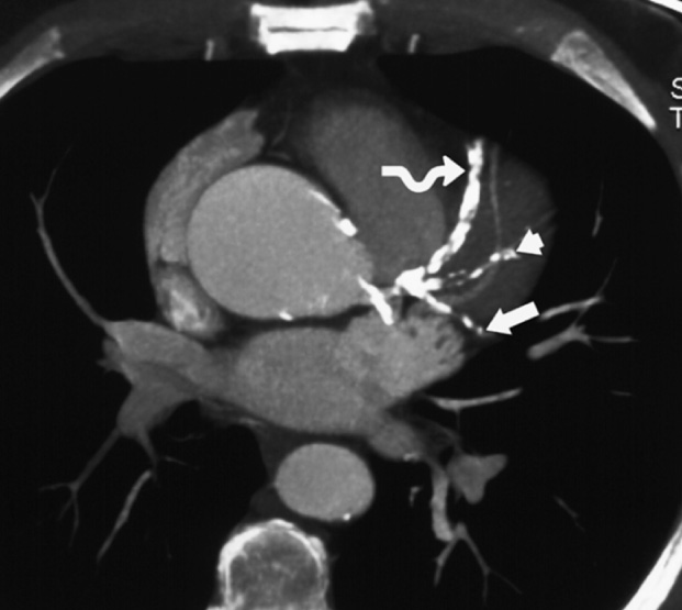 Heavy coronary calcification. Axial thin MIP reconstruction from a coronary CTA shows multiple areas of dense calcification which prevent visualization of most of the arterial lumen in the left anterior descending (LAD) (curved arrow), ramus intermedius (arrowhead), and circumflex (arrow) coronary arteries. An area of low attenuation in the ramus intermedius represents an area of clear occlusion by fatty plaque. *