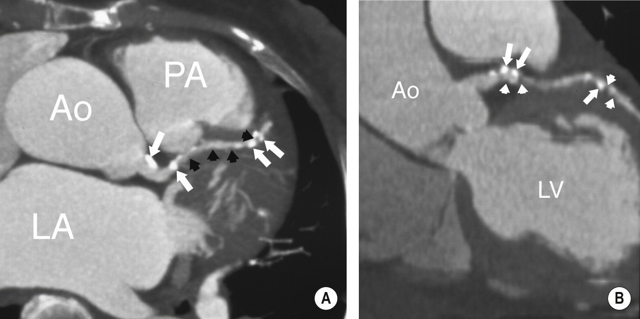 Multiplanar visualization of complex coronary stenoses. (A). Oblique axial thin MIP reconstruction from coronary CTA and orientated along the left anterior descending artery (LAD) shows multiple high attenuation (calcified, arrows) and low attenuation (fatty, black arrowheads) lesions. Ao = aortic root, LA = left atrium, LV = left ventricle, PA = pulmonary artery. (B) Oblique coronal thin MIP reconstruction from coronary CTA shows more of the length of the LAD and multiple high attenuation (calcified, arrows) and low attenuation (fatty, arrowheads) lesions from a different perspective. *