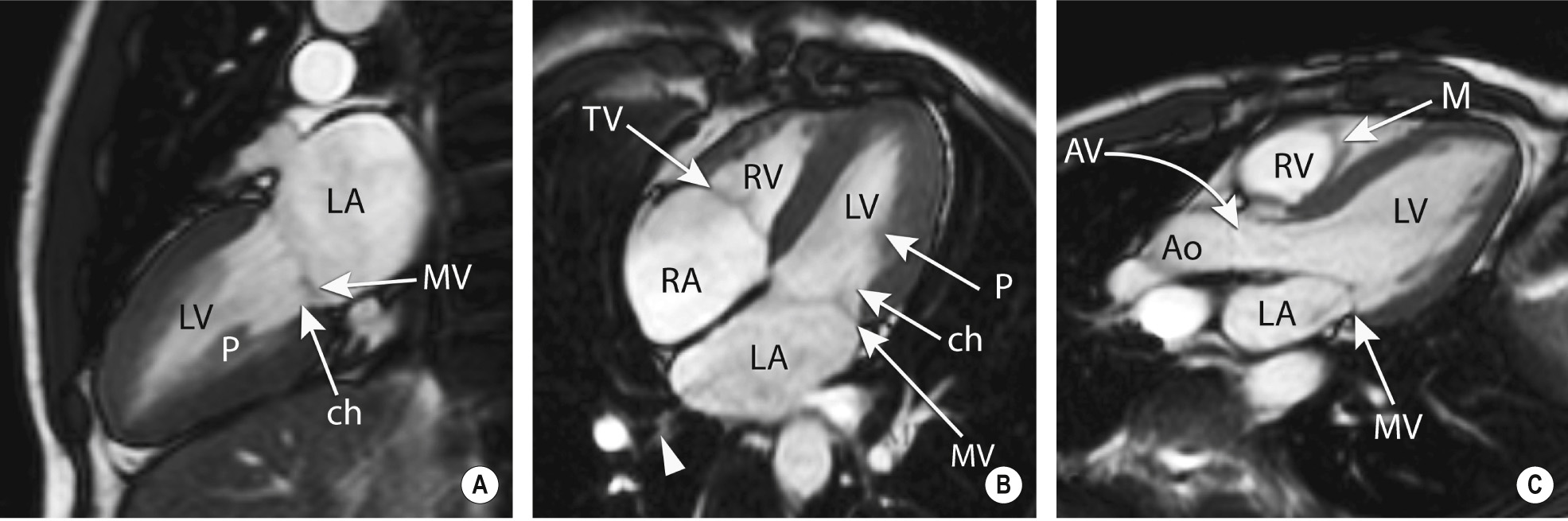 Normal cardiac anatomy on bright blood; two-, four- and three-chamber views. RA, right atrium; LA, left atrium; RV, right ventricle; LV, left ventricle; P, papillary muscle; TV, tricuspid valve; MV, mitral valve; AV, aortic valve; Ao, aorta; M, moderator band; ch, chordae tendineae. **